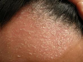 牛皮癣 牛皮癣